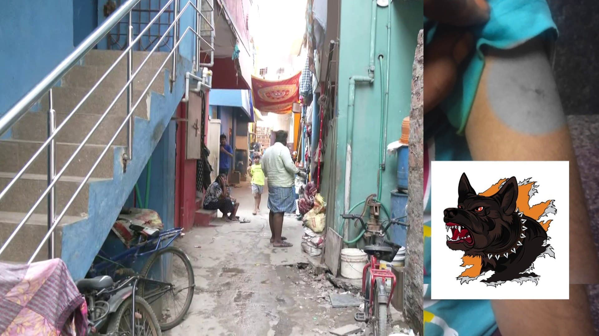 சைதாப்பேட்டையில் 5 வயது சிறுமியை கடித்து குதறிய நாய்