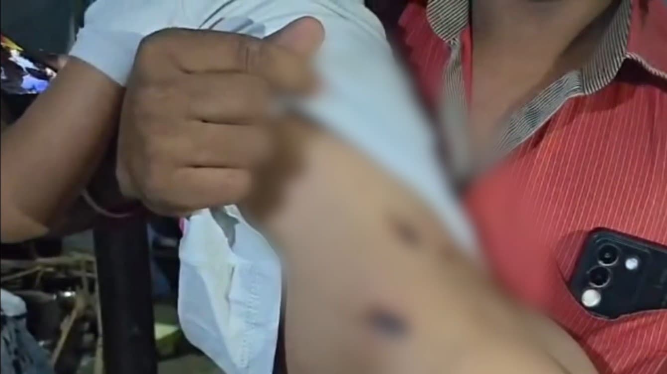 வீட்டின் வெளியே விளையாடிய 4 வயது சிறுவனை கடித்த தெரு நாய்கள்..!